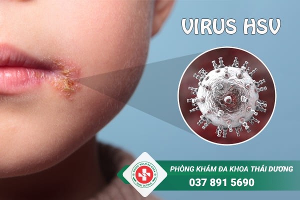 Bệnh mụn rộp ở môi do virus HSV gây ra và lây chủ yếu qua quan hệ tình dục bằng miệng