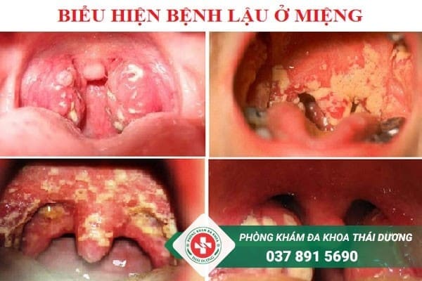 Triệu chứng bệnh lậu ở miệng nam giới qua từng giai đoạn