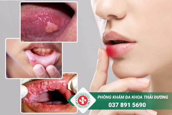 Triệu chứng bệnh sùi mào gà ở miệng dễ nhầm lẫn với bệnh nhiệt miệng