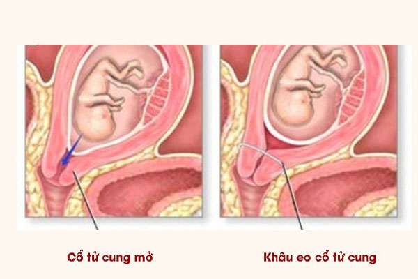 Phụ nữ bị cổ tử cung ngắn có thể áp dụng thủ thuật khâu vòng eo cổ tử cung