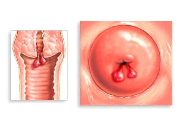 Hình ảnh minh họa bệnh polyp cổ tử cung
