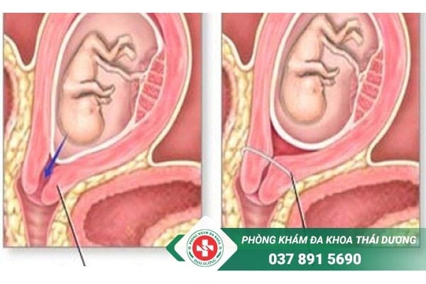Khâu vòng cổ tử cung được chỉ định cho trường hợp hở eo cổ tử cung