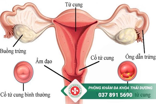 Điều trị tổn thương cổ tử cung tại Biên Hòa