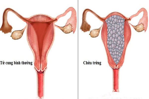 Không thấy phôi thai trong túi thai có thể do mang thai ngoài tử cung