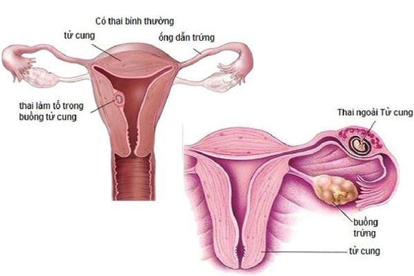 Mang thai trứng cũng là trường hợp khiến siêu âm không thấy phôi thai trong túi thai