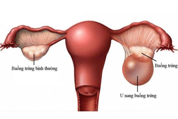 Vòng tránh thai có thể gây u nang buồng trứng cho chị em
