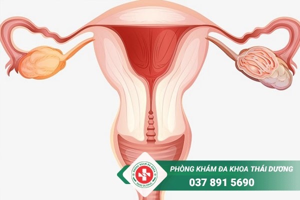 Thực hiện nạo phá thai không an toàn có thể gây dính buồng tử cung