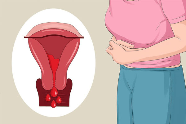 Viêm nội mạc tử cung có thể khiến chị em ra khí hư màu nâu có lẫn máu