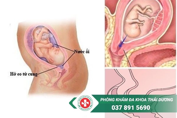 Khâu eo tử cung được chỉ định cho trường hợp bị hở eo tử cung
