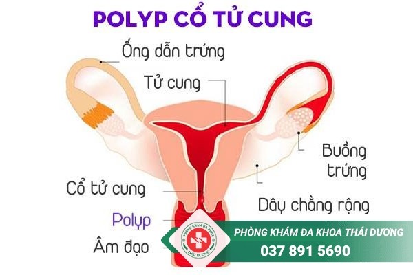 Hình ảnh polyp cổ tử cung