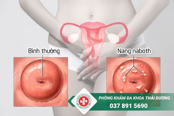 Bệnh nang naboth tử cung là gì?