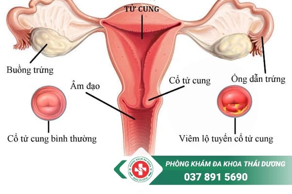 Có nhiều nguyên nhân gây viêm lộ tuyến cổ tử cung ở nữ giới