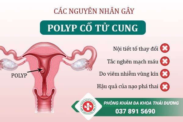 Địa chỉ điều trị Polyp cổ tử cung hiệu quả tại Biên Hòa – Đồng Nai