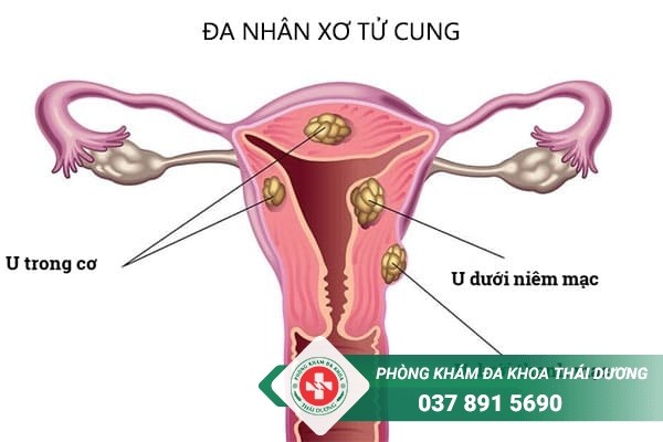 Đa nhân xơ tử cung là bệnh thường gặp ở chị em phụ nữ trong độ tuổi sinh sản