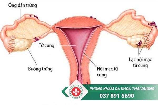 Lạc nội mạc tử cung là bệnh phụ khoa gây đau bụng kinh dữ dội