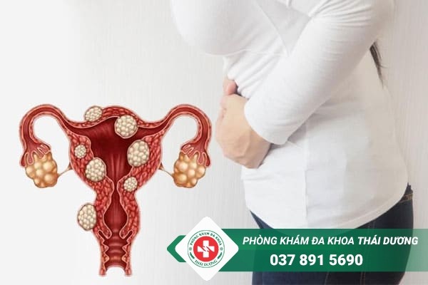 U xơ tử cung là bệnh phụ khoa thường gặp ở chị em nữ giới trong độ tuổi sinh sản