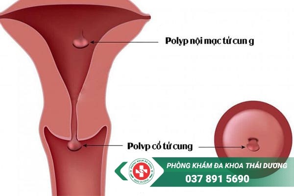 Polyp cổ tử cung là bệnh thường gặp ở chị em phụ nữ mang thai