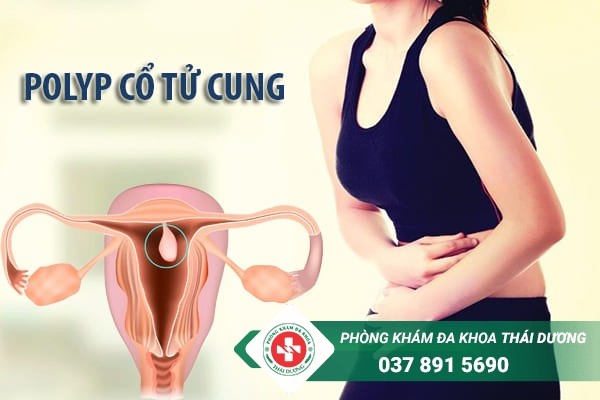 Polyp cổ tử cung gây ra nhiều biến chứng nguy hiểm nếu chậm điều trị