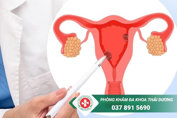 Sự xuất hiện của khối Polyp cổ tử cung khiến quá trình thụ thai khó xảy ra