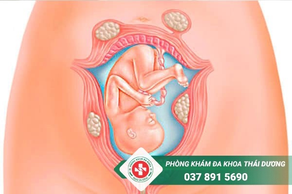 Bệnh lý u xơ gây ra nhiều biến cho thai phụ và thai nhi