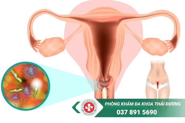 Viêm âm đạo là bệnh lý phụ khoa thường gặp ở nữ giới