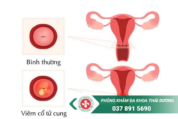 Hình ảnh minh họa viêm cổ tử cung