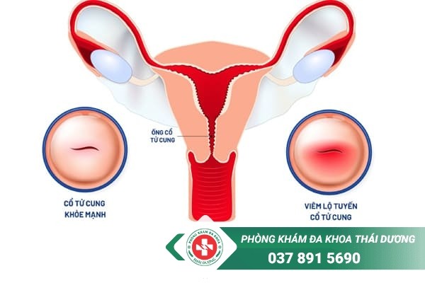 Viêm lộ tuyến cổ tử cung là bệnh lý thường gặp ở nữ giới trong độ tuổi sinh sản