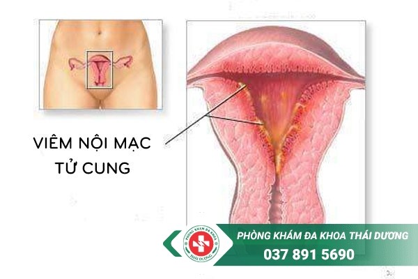 Viêm nội mạc tử cung là bệnh thường gặp ở chị em nữ giới