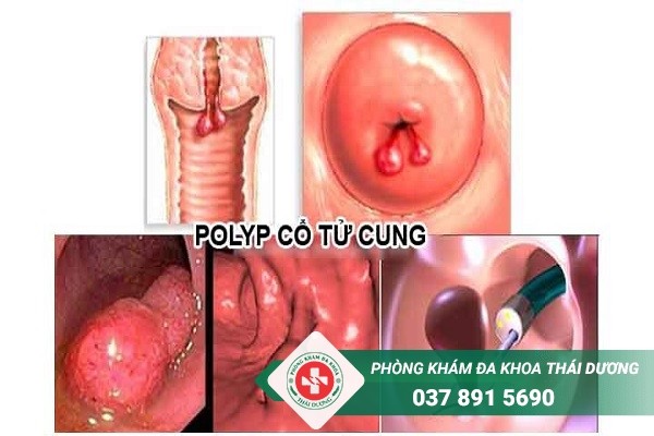 Phương pháp điều trị polyp cổ tử cung