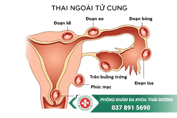 Thai ngoài tử cung có thể gây ra nhiều biến chứng nguy hiểm cho thai phụ