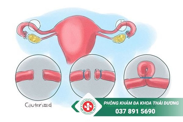 Thắt buồng trứng được biết đến là phương pháp tránh thai vĩnh viễn