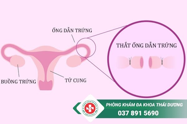 Biện pháp tránh thai thắt ống dẫn trứng là gì?