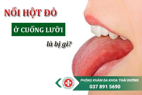 Cuống lưỡi nổi hột đỏ là dấu hiệu của bệnh xã hội và bệnh ở miệng