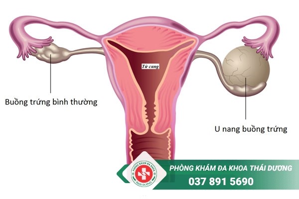 Đau bụng dưới bên phải gần háng có thể do u nang buồng trứng
