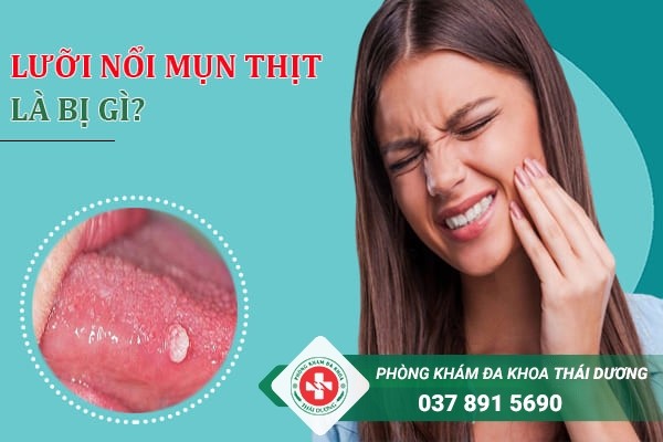 Nổi mụn thịt đỏ ở lưỡi, miệng là triệu chứng của một số bệnh lý