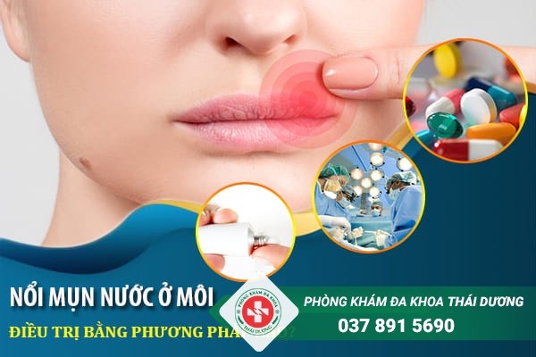 Nổi mụn nước ở miệng thường được điều trị bằng thuốc