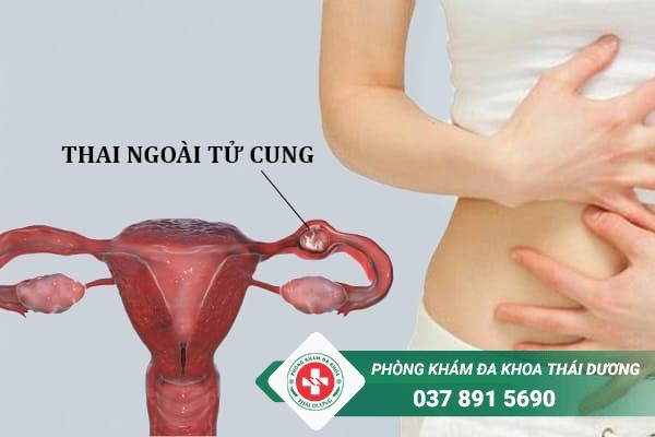 Nữ giới bị đau bụng dưới bên trái gần háng có thể là dấu hiệu chửa ngoài dạ con